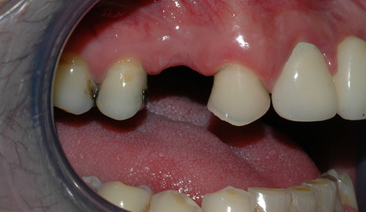 Bildet viser en manglende tann i overkjeven. Nabotennene har fyllinger og slitasje, og tilfellet egner seg derfor godt for brobehandling.