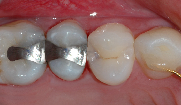 Bildet viser en tann med fargeforandring under emaljen, noe som tyder på et hull.
