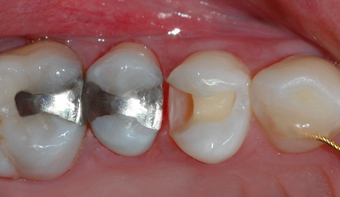 Tannen er ferdig borret og klargjort for fyllingsterapi.
