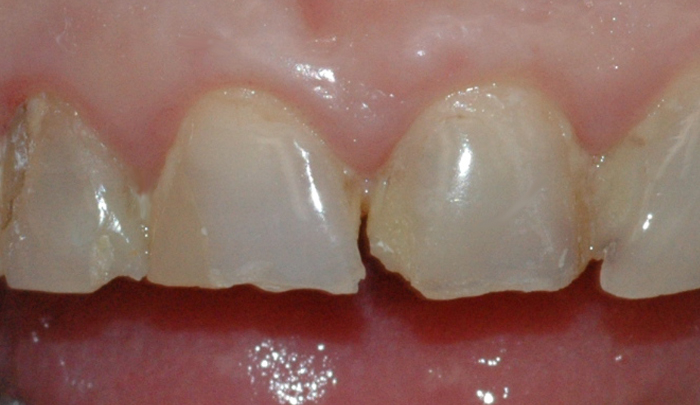 Bildet viser fortenner med utette fyllinger, frakturer og slitasjeskader som følge av tanngnissing.