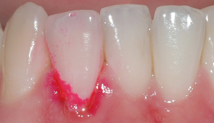 Ved å benytte et fargestoff, kan man lettere se belegget som er årsak til betennelsen i tannkjøttet.