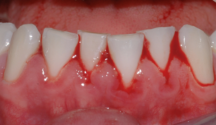 Tannkjøttet blør kraftig når pasienten pusser tennene. Ved godt renhold over tid, vil betennelsen forsvinne.