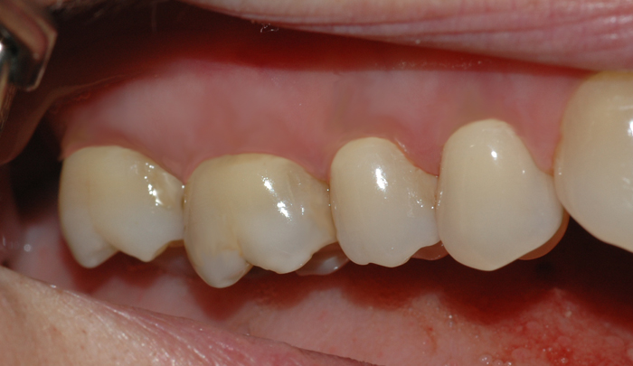 Bildet viser tenner i overkjeven med normale tannkjøttsforhold.