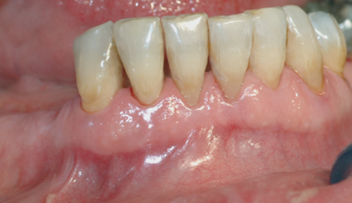Bildet viser tilsynelatende normale tannkjøttsforhold ved tenner i underkjeven.