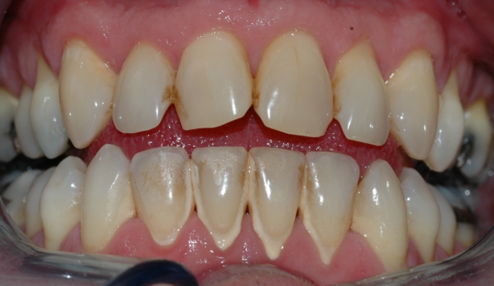 Bildet viser et nærbilde av tennene i underkjeven med tannstein og misfarging.
