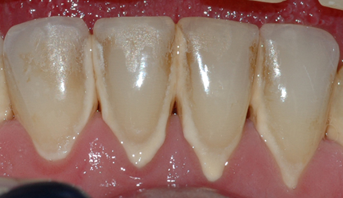 Bildet viser forholdene i underkjeven etter at tannstein og misfarging er fjernet