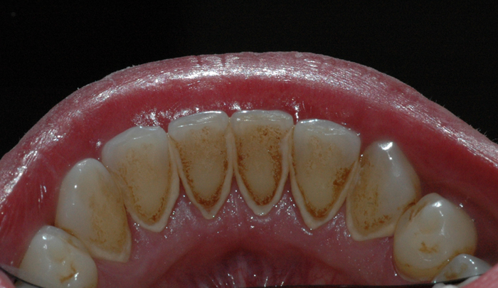 Her kan man se misfarging og tannsten på tennenes innside. 