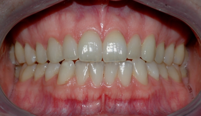 Bildet viser tenner før bleking. Tennene har ingen synlige fyllinger og kan derfor egne seg godt for bleking.