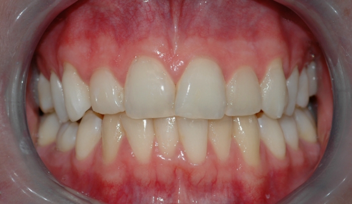 Bildet viser tenner før bleking. Tennene har ingen synlige fyllinger og kan derfor egne seg godt for bleking