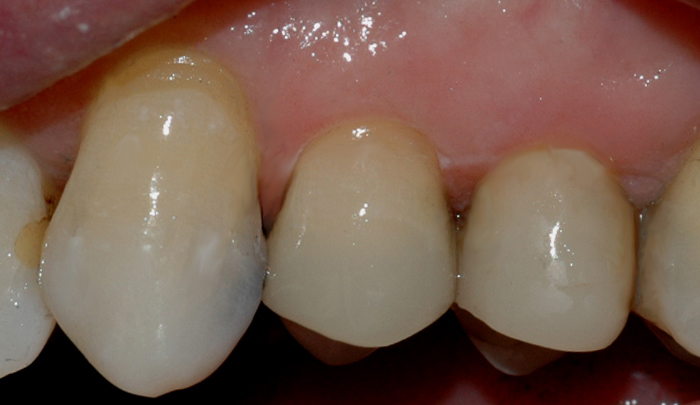 Bildet viser at den gjenstående amalgamfyllingen er fjernet, og at tannen er bygget opp igjen med en plastfylling.