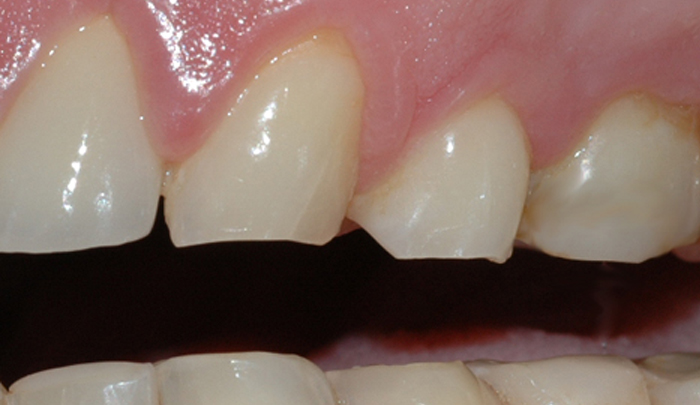 Et detaljbilde viser rette, slitte kanter på tennene. 