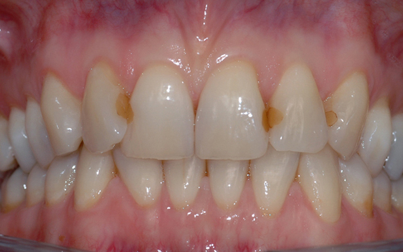 Bildet viser tenner i overkjevens front med diverse synlige fyllinger. Pasienten ønsket å bytte fyllingene da de virket skjemmende i et ellers pent smil.
