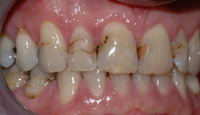 Bildet viser tenner med diverse synlige fyllinger. Flere av fyllingene er dårlig tilpasset og har hull i kantene.