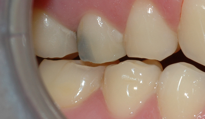 Bildet viser en tann med blålig misfarging, som følge av gjennomskinn fra en amalgamfylling.