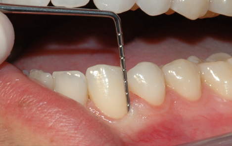 Tannkjøttet og tennenes benfeste blir vurdert.