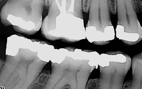 Røntgenbilder viser blant annet begynnende hull, behandlingskrevende hull, gamle fyllinger og tennenes benfeste.