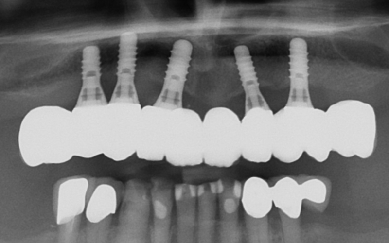 Et OPG-røntgen viser hvordan implantatene står i kjeven.