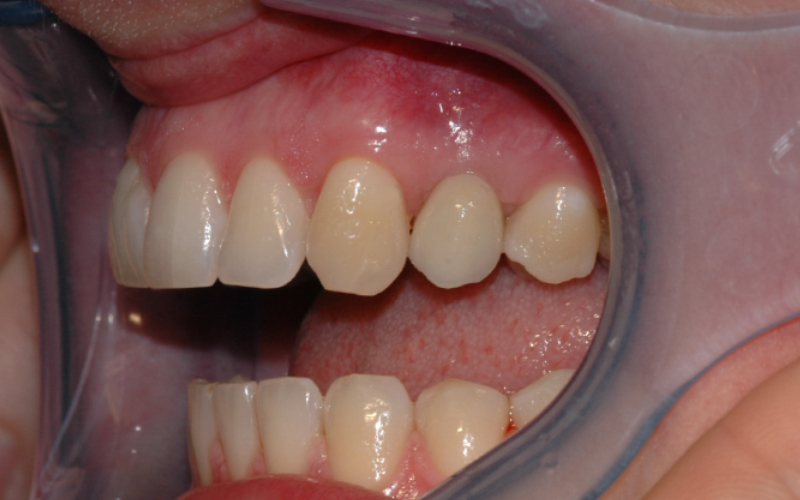Bildet viser implantatkronen satt på plass. Det er viktig å holde godt rent rundt implantatet for å forebygge tannkjøttsbetennelse.